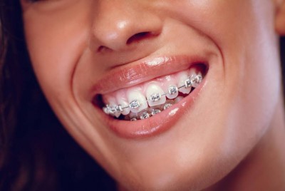 Metallic Braces