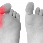 bunion